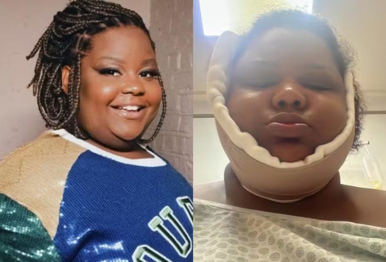 A funkeira MC Carol mostrando o resultado da lipoaspiração de papada em suas redes sociais