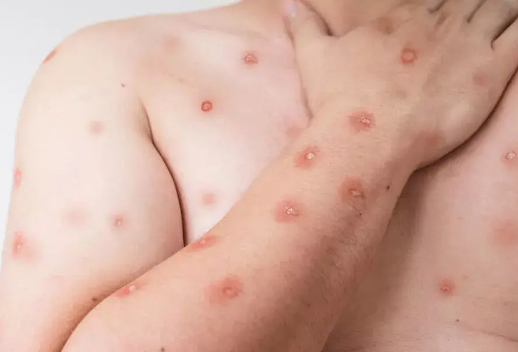 Prefeitura de Araruama afirma que não há registros de pacientes com mpox na rede municipal