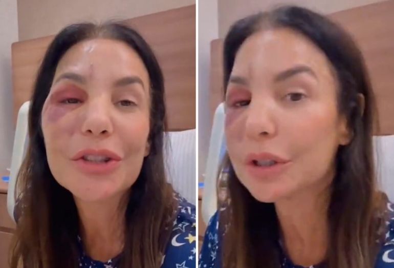 Ivete Sangalo detalha cirurgia de reconstrução óssea no rosto e exibe pós-operatório